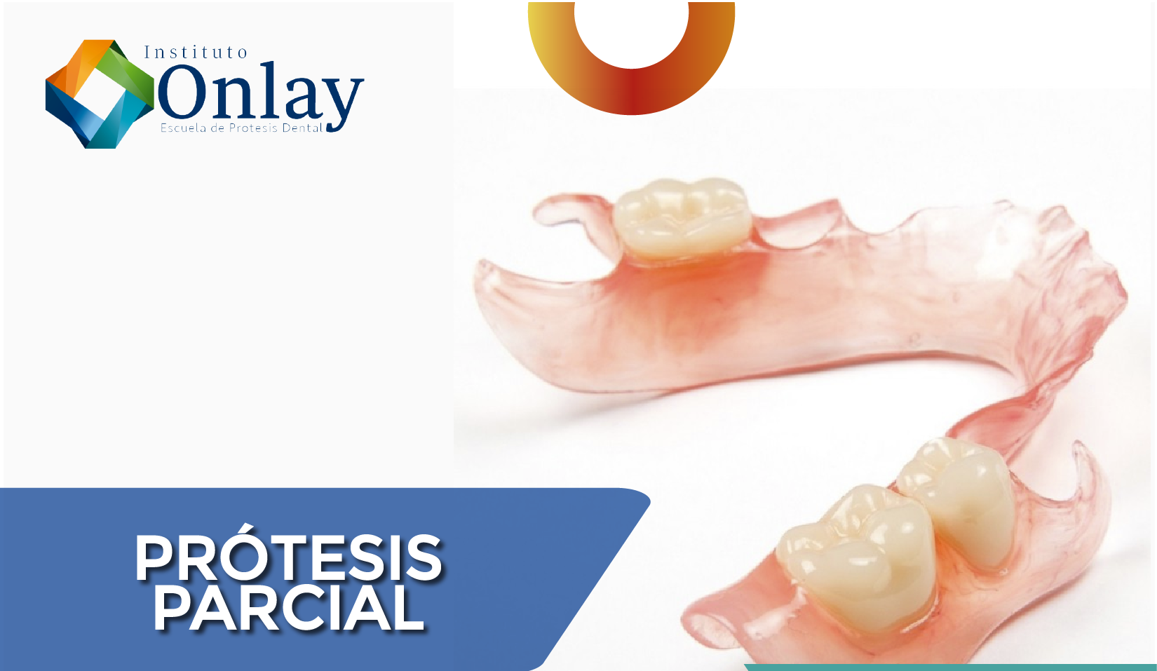Prótesis Parcial Removible